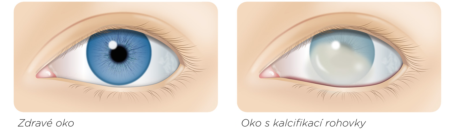 Zdravé oko versus oko s kalcifikací rohovky